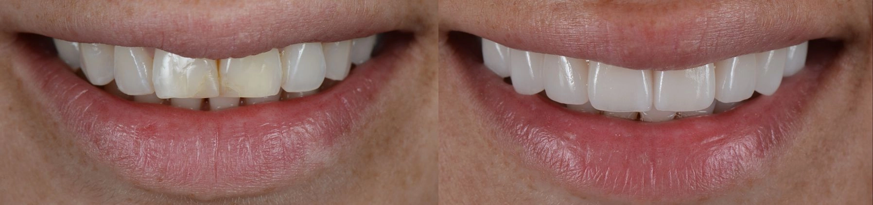 before and after picture